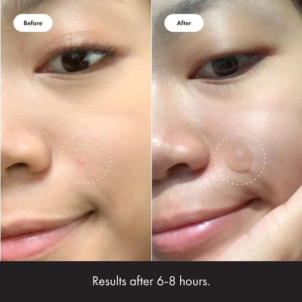✨ 2024 Hydrocolloid Acne Cover Patches(🔥Buy 3 Get 3 Free)