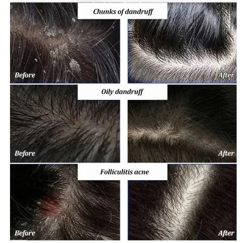 Anti-Dandruff Artemisia Conditioner-【BUY 2 GET 1 FREE】