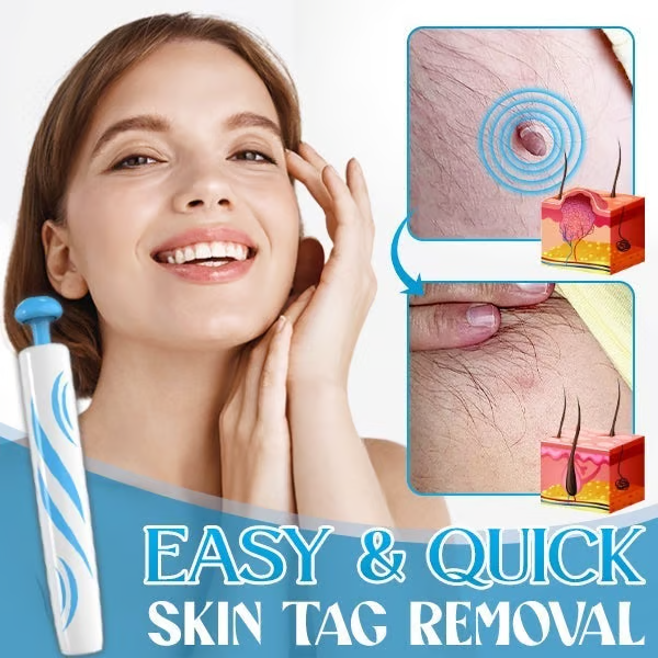 Auto Micro Skin Tag Remover🎁