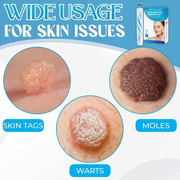 Auto Micro Skin Tag Remover🎁
