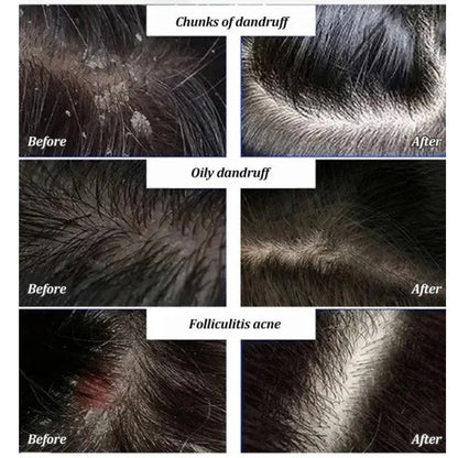 Anti-Dandruff Artemisia Conditioner-【BUY 2 GET 1 FREE】